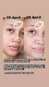 Berikut ini adalah review produk yang mengandung retinol dari avoskin miraculous ampoule retinol dan somethinc 1 % untuk mengatasi flek hitammention product1. Avoskin Miraculous Retinol Series
