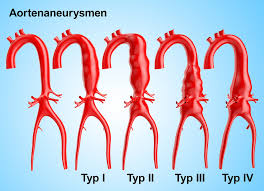 Notfall An Der Aorta Das Aneurysma Hgz Bad Bevensen