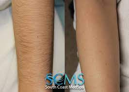 The hair under my arms is dark, rough, and wiry, but it also grows back so damn fast. Juni 2018 Laser Tattoo Removal In Process