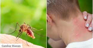 Google's free service instantly translates words, phrases, and web pages between english and over 100 other languages. Gatal Akibat Gigitan Nyamuk Berpunca Dari Air Liurnya Ini Penjelasannya