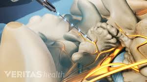Image result for Radiofrequency Surgery