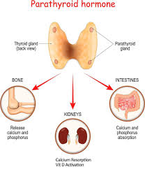 Image result for Hyperparathyroidism