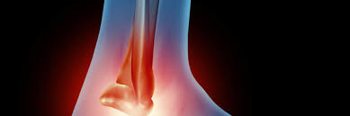 Common Foot And Ankle Injuries From Football Rothman Orthopaedic Institute