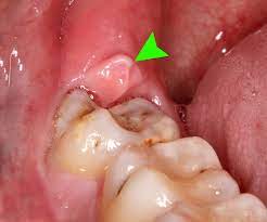 Hard food may cause damage, so avoid those types of food. Pericoronitis Wikipedia