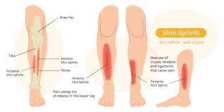 Preventing And Treating Shin Splints | Sterosport