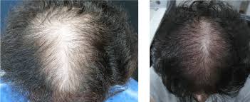 Outside of these passions, stacie can be found. Clinical Evaluation Of A Novel Fractional Radiofrequency Based Device For Hair Growth Stimulation