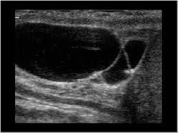 More images for tubular ectasia of rete testis radiology » Urinary Tract And Male Reproductive System 2 3 Scrotum Case 2 3 2 Hydroceles Cysts And Tubular Ectasia Ultrasound Cases