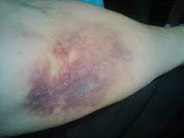 Bruising is often not serious. Why Is The Skin Surrounding The Area Where I Had My Blood Drawn Yellow Quora