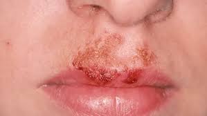 Image result for Impetigo
