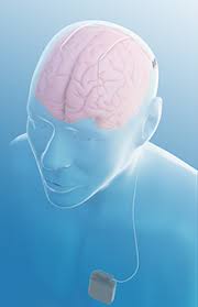 Image result for Thalamic Stimulation