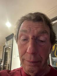 Nose fracture treatment options: freeze or surgery?