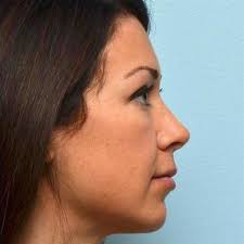 The same principals above apply for moderate jowls, only more so. Jaw Fillers Bellisimos Aesthetics