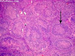 Histopathology Images Of Hodgkin Lymphoma Nodular Lymphocyte Predominant Type By Pathpedia Com Pathology E Atlas