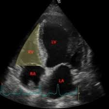 Image result for Right Heart Failure