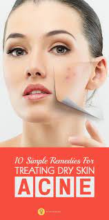 12 Home Remedies To Remove Acne From Dry Skin Dry Skin Acne Dry Skin On Face Dry Skin Care