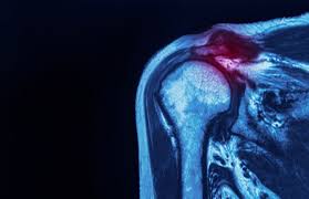 Image result for Rotator Cuff Injury