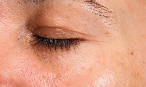 Image result for Solar Lentigo