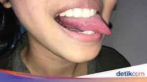 Penyebab sariawan yang umum adalah saat daya tahan tubuh melemah, kekurangan vitamin b12 dan asam folat serta adanya infeksi bakteri atau jenis virus tertentu. 9 Obat Sariawan Alami Ini Bikin Kamu Bisa Makan Enak Lagi