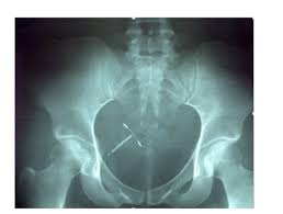 I would appreciate any thoughts or advice. Laparoscopic Removal Of A Migrated Intra Uterine Device Embedded In The Anterior Abdominal Wall In Yaounde Cameroon A Third World Country