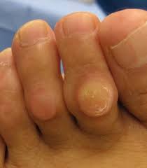 Callus and corn on the sole of the foot — podiatry treatment and removal