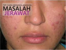 Terima kasihh atass kunjungan anda selamat menikmati video kami selamat menonton bntu dong suncreb chanel ke sayangn kami ok terima. Tip Cara Hilangkan Jerawat Blog Kecantikan Kesihatan Kulit