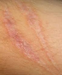 Leg Bio Oil Before And After Scars Pin On Ebenezer