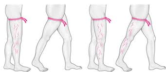 Image result for Perthes Test