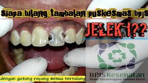 Maybe you would like to learn more about one of these? Setelah Ditambal Bagus Gigi Depannya Ibu Ini Bisa Tersenyum Lepas Tambalan Gigi Depan Youtube