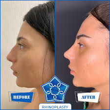 Rhinoplasty, also recognized as a nose job, is a surgical process to  reshape the nasal skeleton which results in changed underlying structures  so that the form and function of the nose will
