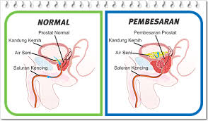 Senaman kemut untuk atasi masalah kencing tak lawas. Adakah Anda Ingin Mengatasi Gejala Kerap Kencing Kencing X Lawas Jika Mengalami Kencing Kerap Dan Tak Lawas Itu Tanda Prostat Membengkak