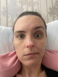 Bell's palsy