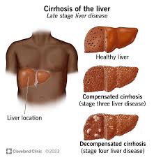 Medical illustration of cirrhosis: healthy liver compared to compensated and decompensated cirrhosis with liver location in the torso