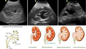 The Ultrasound Mimics Of Hydronephrosis Renal Fellow Network