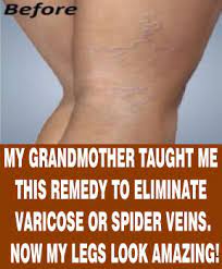Pin On Varicose Veins