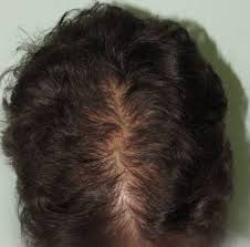 Un ragazzo su 5 (il 18% del campione di analisi) di età compresa tra i 12 e i 20 anni soffre di calvizie giovanile e quindi perdita dei capelli . La Caduta Dei Capelli Negli Adolescenti Cause E Sintomi