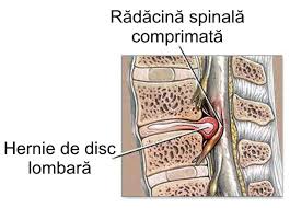 Hernia de disc poate apare in orice parte a coloanei vertebrale, de cele mai multe ori la nivelul inferior al coloanei (zona lombara). Hernia De Disc Ce Este Si Cum Tratam Durerile Cauzate De Aceasta