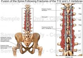 These generally result in some loss of function in the hips and legs. Fusion Of The Spine Following Fractures Of The T12 And L1 Vertebrae Medical Illustration Human Anatomy Drawing Anatomy Illustration