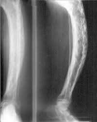 Paget S Disease Pathology Orthobullets