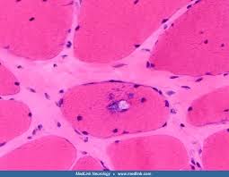 The epidemiology of sstis is evolving. Distal Myopathies Medlink Neurology