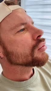 POV: Nadia in her pretty girl era ✨ serving flawless results with an  ablative facial at Amore Skin & Wellness Center. Glow up activated! ✨  #AmoreGlow #PrettyGirlEra #SkinGoals