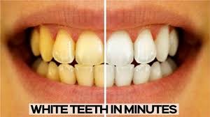 How To Whiten Your Teeth Easy And Quick Teeth Whitening Youtube
