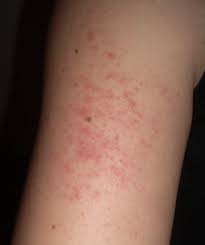 Stress Rash Stressbusting