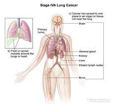 A pancoast tumor is a type of lung cancer that grows in the upper part of your lung and spreads to your ribs, vertebrae in your spine, nerves, and blood vessels. Lung Cancer Medlineplus Genetics