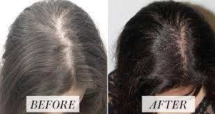 For a reliable hair loss treatment that's available otc and has minimal side effects, look no further than rogaine. Hair Loss Treatment In Mumbai Cost Hair Specialist Doctor In Mumbai