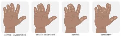Image result for Syndactyly