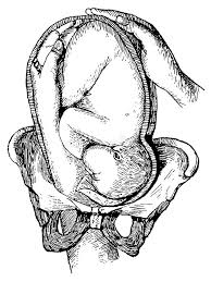 Image result for Shoulder Presentation