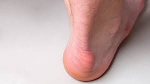 This condition is often precipitated by wearing shoes with rigid backs that rub against the heel. Apma On Twitter Commonly Known As A Pump Bump Haglund S Deformity Creates A Visible Bony Prominence At The Back Of The Heel Bone And Could Cause Intense Heel Pain Find Out How