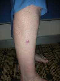 As with many cancers, skin cancer develops when damaged cells grow uncontrollably. Skin Cancer Surgery Skin Cancer Leg With Local Flap Repair Dr Damian Marucci Cosmetic Plastic Reconstructive Surgeon