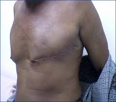 At medigo, a handful of the 80,000 patients we first of all, it is important to know how to check yourself for any early signs of breast cancer. All You Need To Know About Male Breast Cancer Now