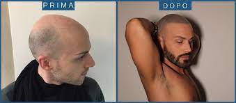 La micropigmentazione applicata ai capelli è una tecnica del tutto innovativa, nata per mascherare inestetismi come la calvizie o per coprire cicatrici . Pigmentazione Capelli La Soluzione Definitiva Che Si Prende Cura Della Calvizie Micropigmentazione A Vicenza E Padova Veneto Milano E Brescia Lombardia E Trento Trentino Informati Sui Nostri Costi Vantaggiosi Anche Dal Tuo Tricologo